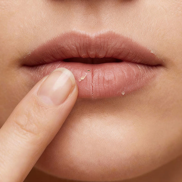 LABIOS SECOS Y TIRANTES DESDE EL MEDIODÍA